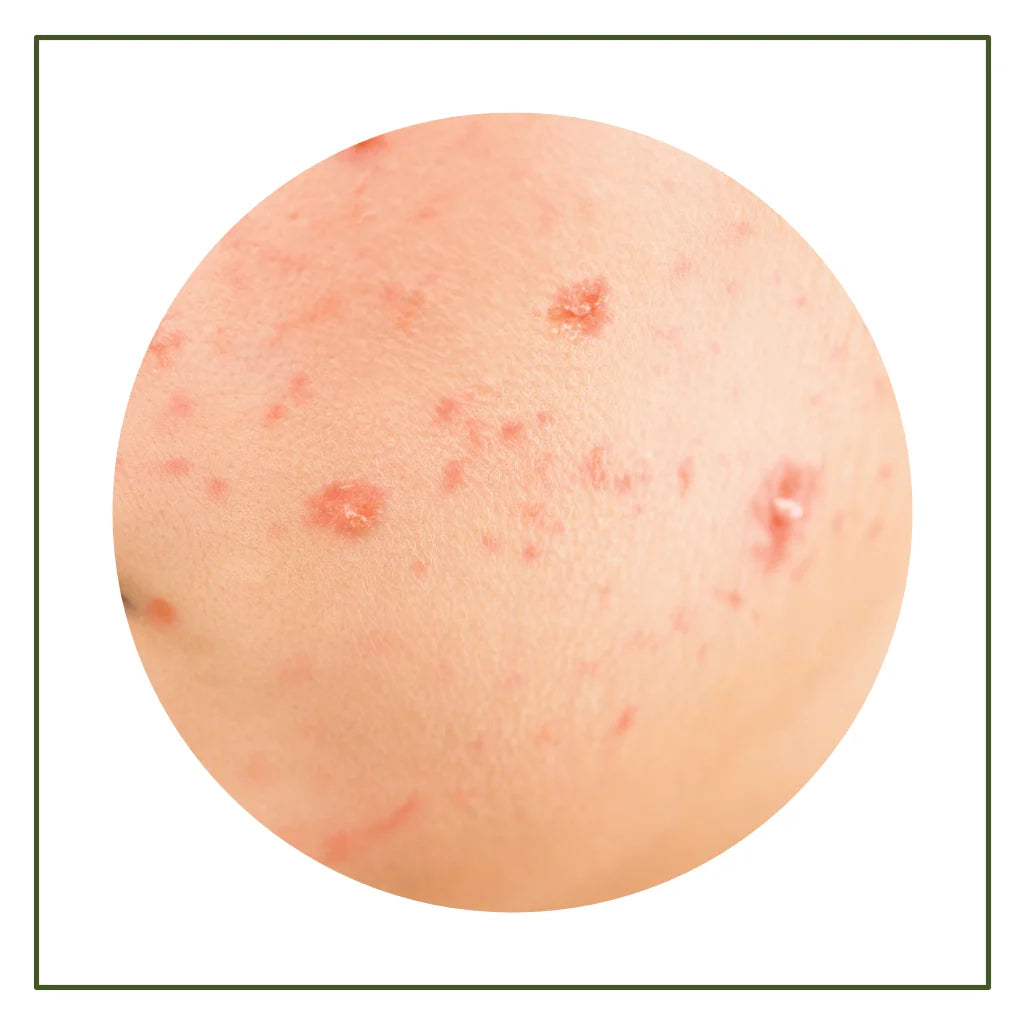 Acne & Pimples