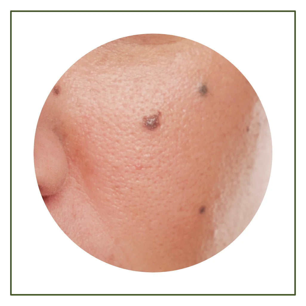 Dark Spots & Pigmentation
