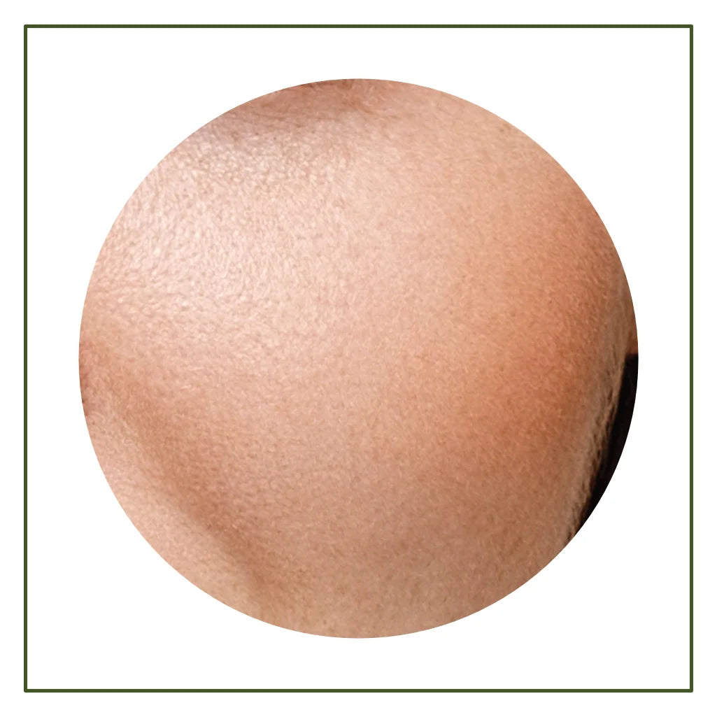 Dry & Dehydrated Skin
